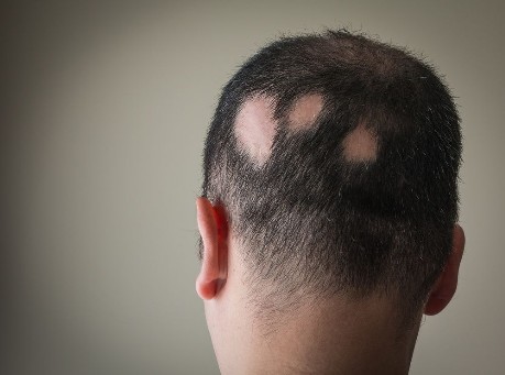 Alopecia uomo e donna cause e soluzioni tricologiche