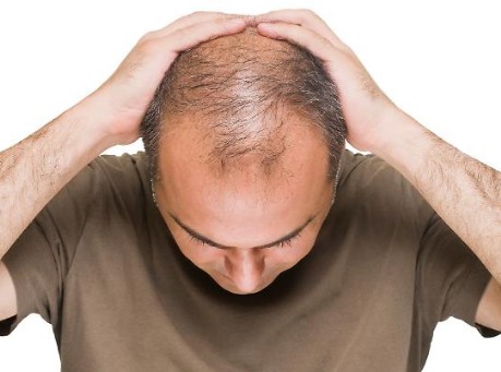 Alopecia e Calvizie troviamo la soluzione insieme a te