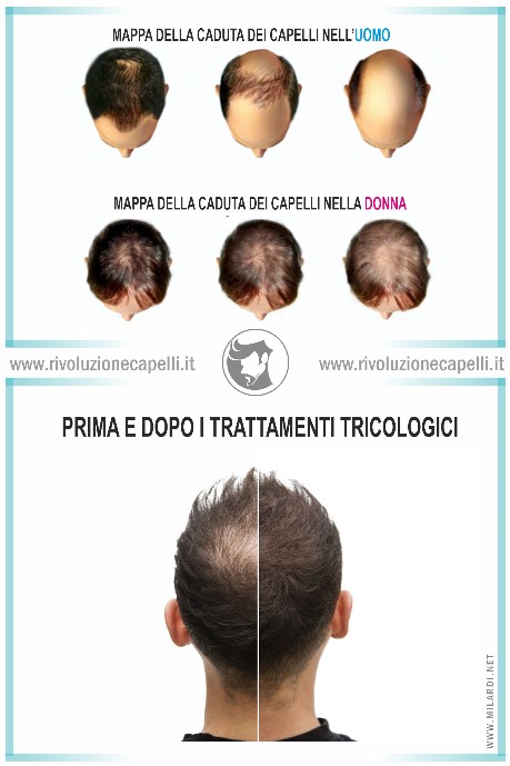 Perdita Capelli Rivoluzione Capelli Tricologia avanzata cura anti caduta